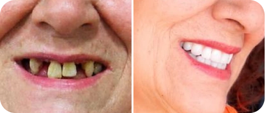 Resultado antes e depois de implante dentário