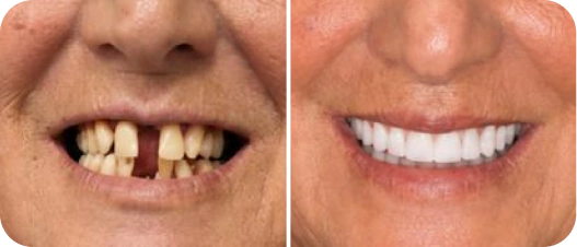 Resultado antes e depois de implante dentário