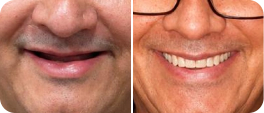 Resultado antes e depois de implante dentário