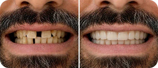Resultado antes e depois de implante dentário