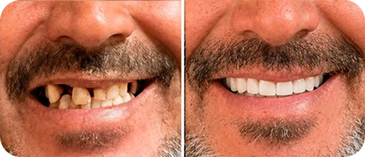 Resultado antes e depois de implante dentário