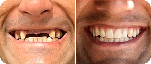 Resultado antes e depois de implante dentário